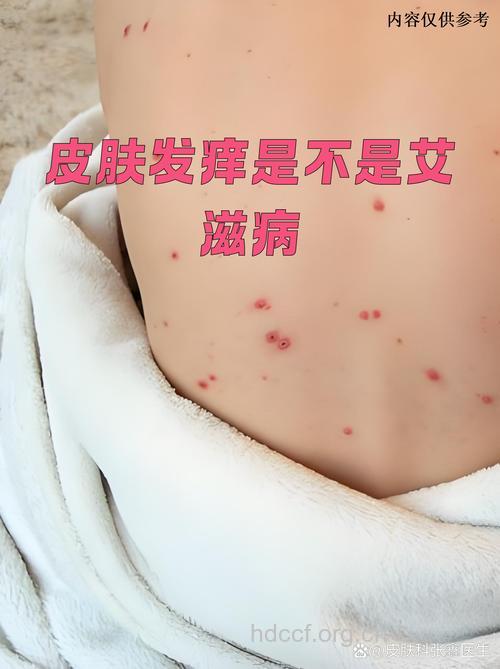 皮肤瘙痒是不是感染上艾滋病呢