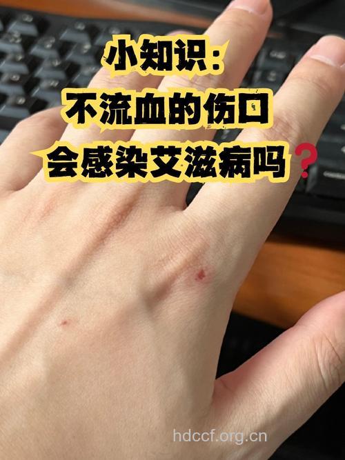 艾滋病患者咬人会不会感染？
