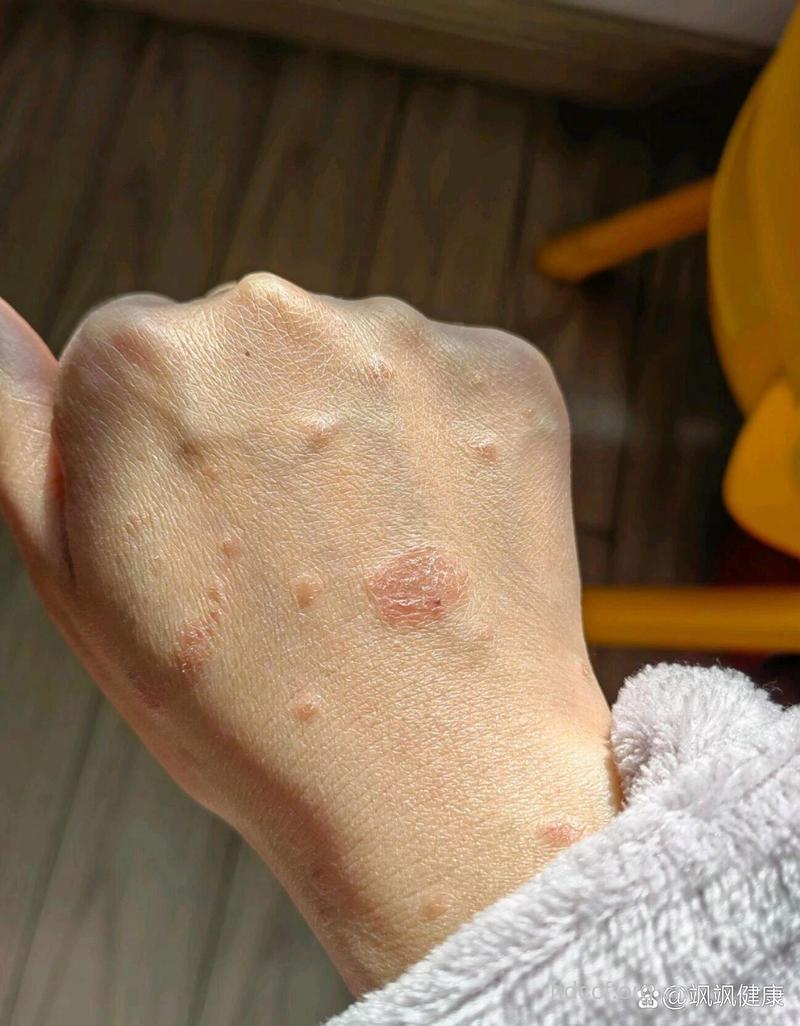 牛皮癣的初期症状图片