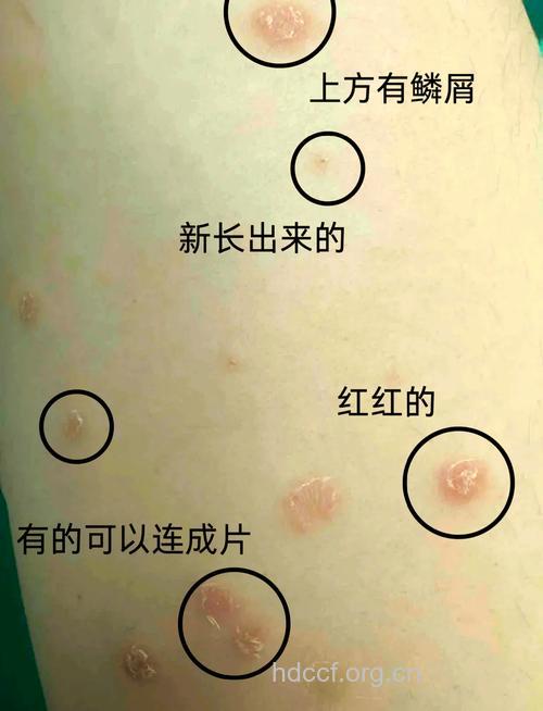 如何鉴别初期牛皮癣