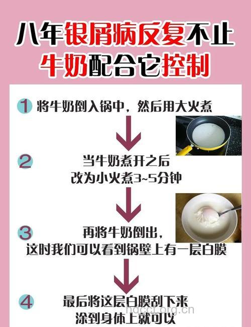 银屑病喝牛奶要注意什么