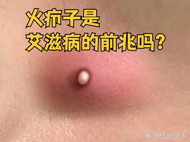 艾滋病病发会流脓吗
