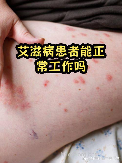 不适宜艾滋病感染者的工作