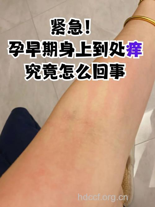 孕期皮肤瘙痒 别盲目自治