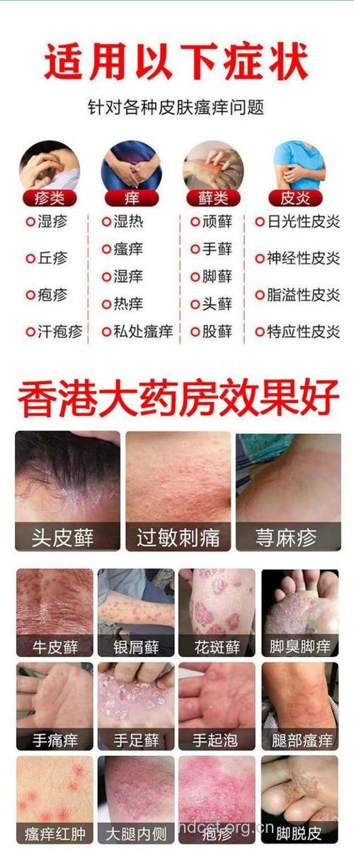 全身瘙痒 如何选用药物？