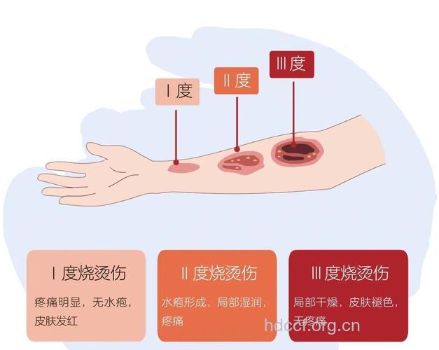 常见的烧伤及临床表现