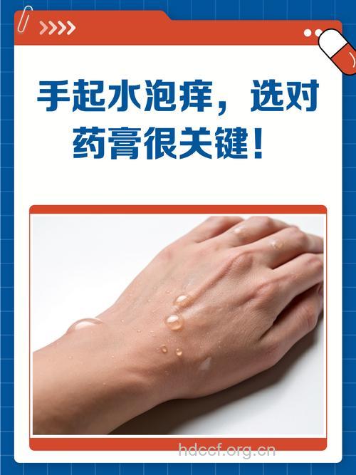 手上起泡一般用什么药好？