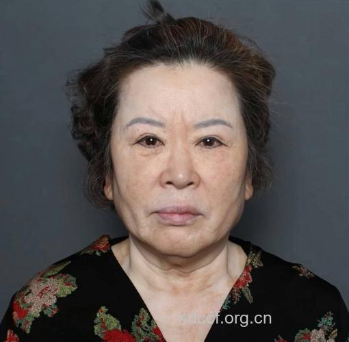 皮肤松弛症让少女看似老太婆(图)