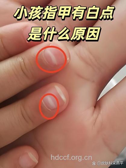 宝宝指甲提示九大皮肤病!
