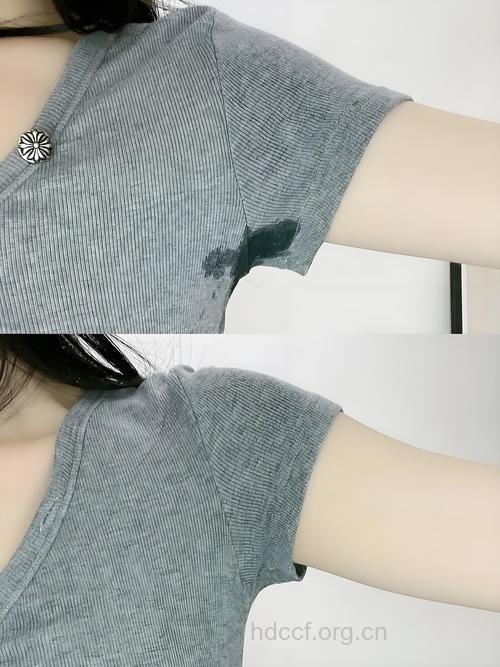 揭秘！止汗露背后隐藏的疾患