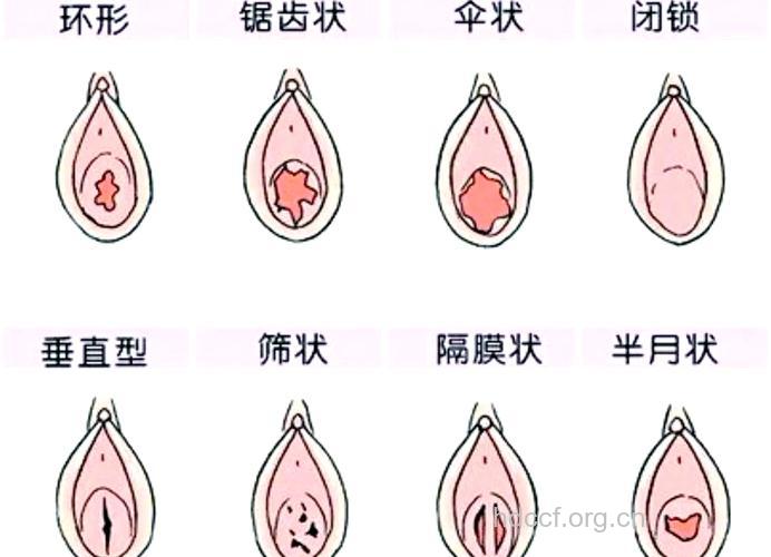 女性处女膜的真面目