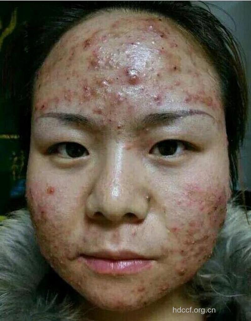 青春痘竟然“钟情”70后！