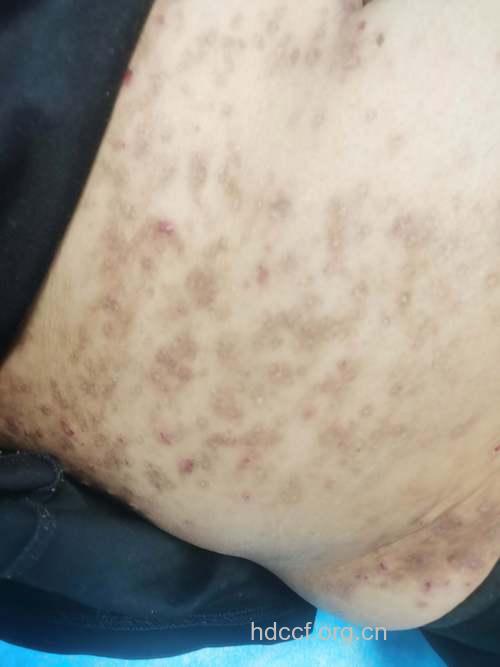 大学生电子公司实习竟染上皮肤病