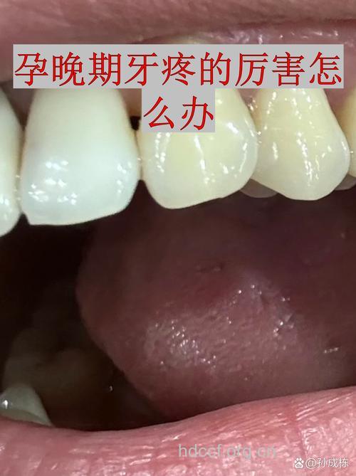 孕妇牙痛的症状有哪些