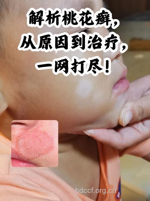 染上桃花癣别怪桃花