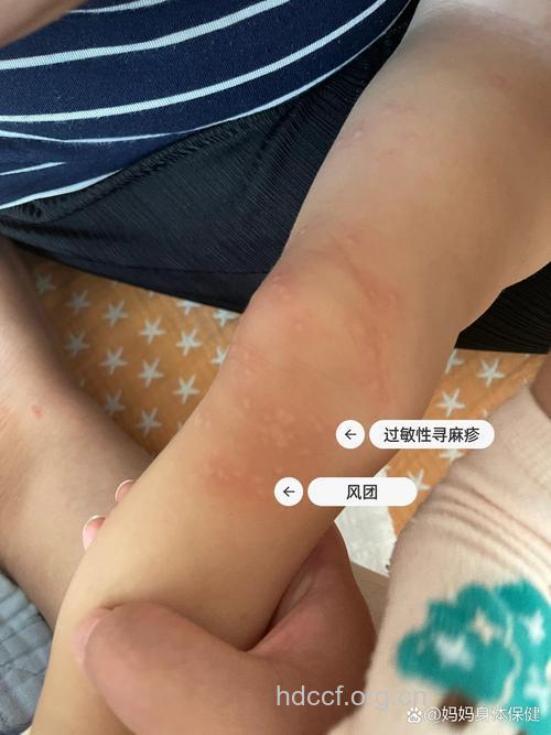 宠物容易引起小儿皮肤过敏