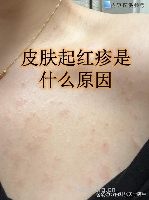 过敏性皮肤病“防不胜防”