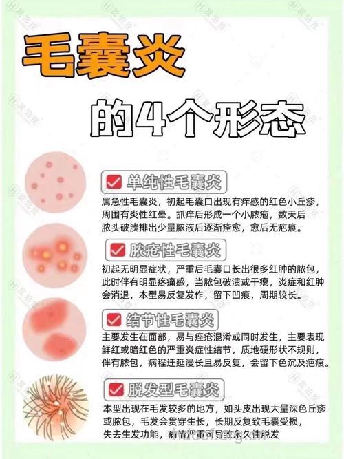 引起毛囊炎的几个主要原因