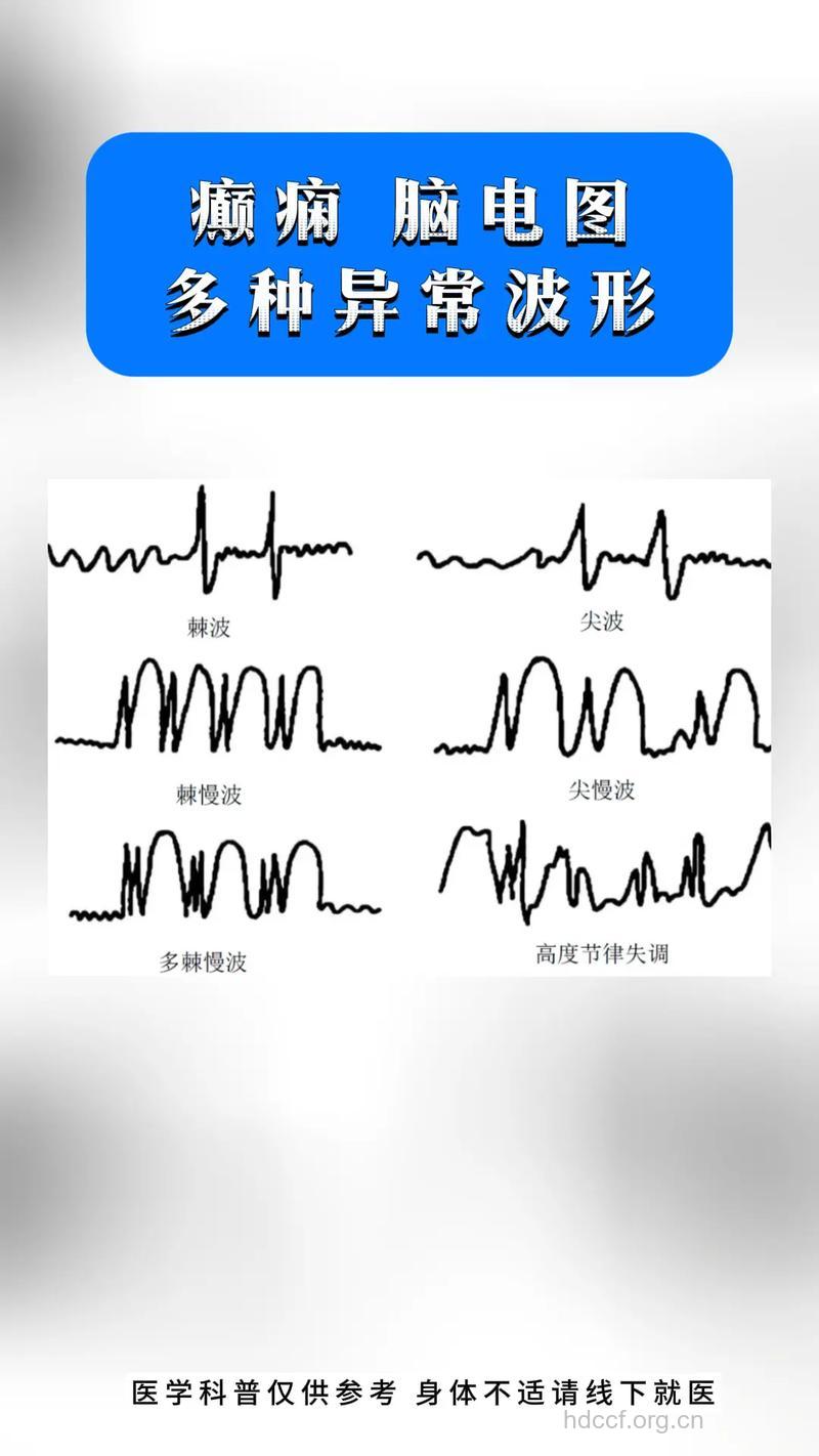 闪光和电磁波会导致癫痫发作