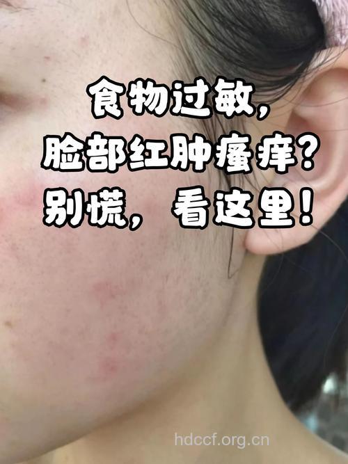 瓜果贴脸小心过敏