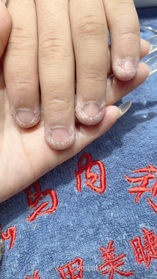 经常咬指甲当心甲沟炎爆发