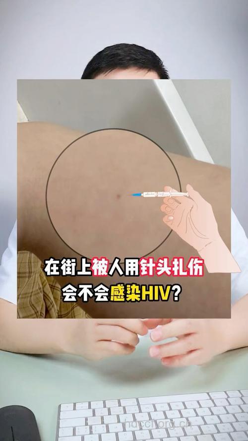 被艾滋病针筒扎了会被感染吗
