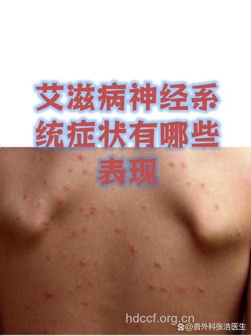 艾滋病病毒对中枢神经系统的损害