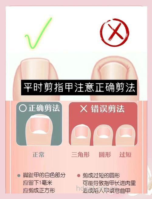 甲沟炎偏方 治疗甲沟炎的方法