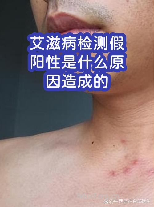 艾滋病检测假阳性的三大原因