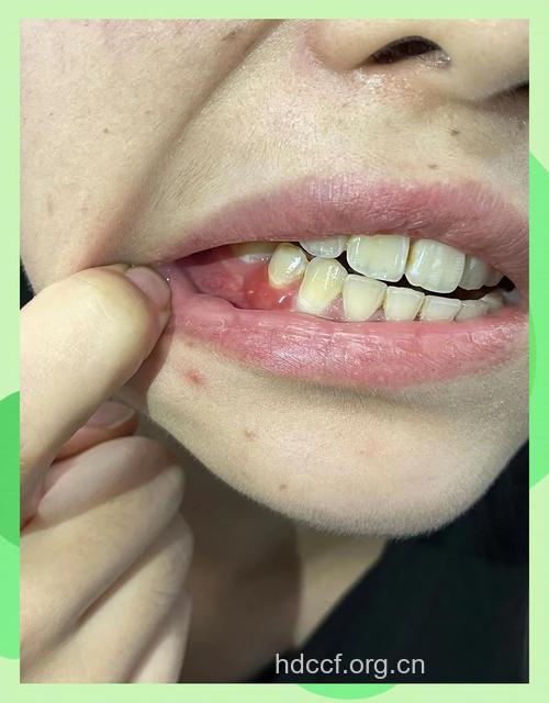牙龈肿痛2年原来是牙齿内有药棉