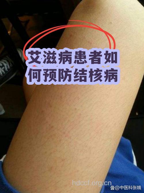 艾滋病患者高达八成死于结核病