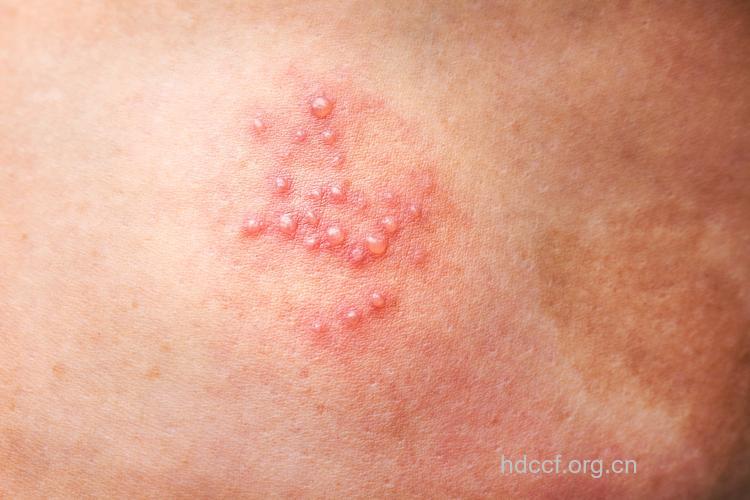 病毒性疱疹的症状表现是什么