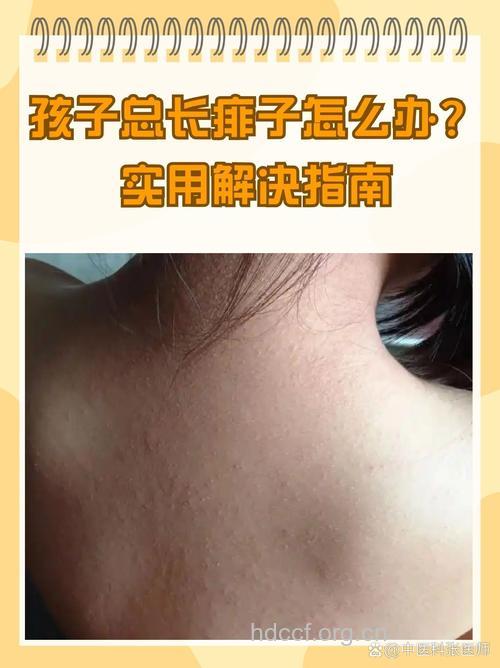 胖宝宝为什么更容易长痱子