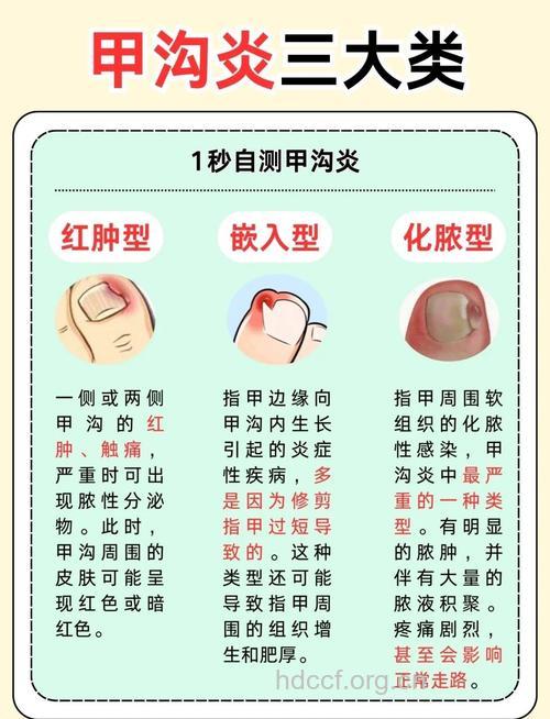 远离甲沟炎的几个生活小细节