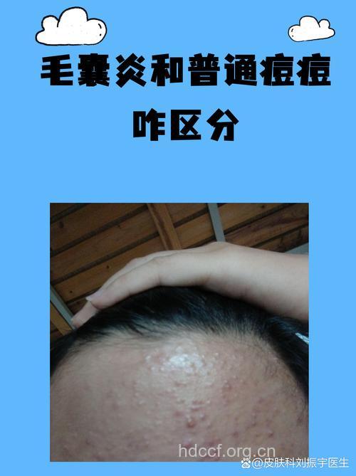 区分毛囊炎和青春痘的方法