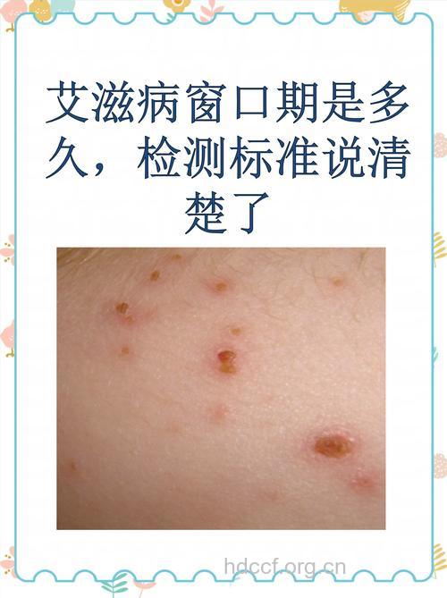 艾滋病的窗口期有多久