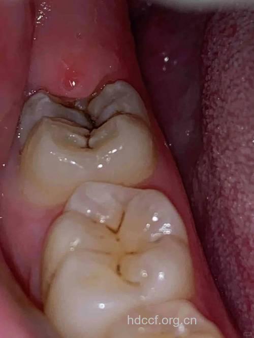 大牙窝沟发黑要特别注意 你已经蛀牙啦