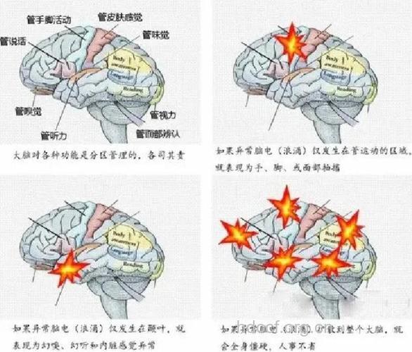 脑肿瘤和癫痫之间的关系