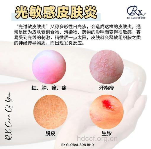 光敏质皮肤喝柠檬水易得红疹