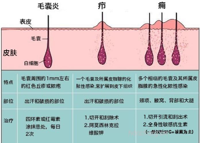 女性朋友阴毛囊炎了解吗