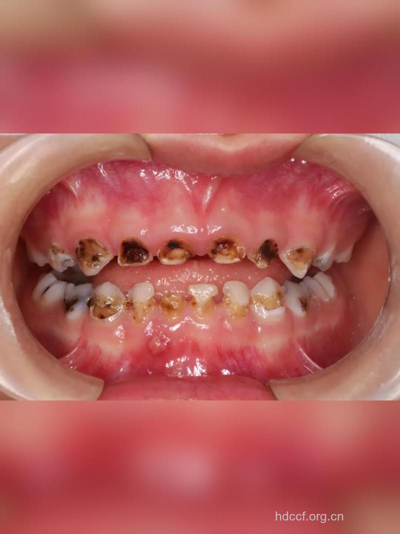 龋齿的症状表现有哪些