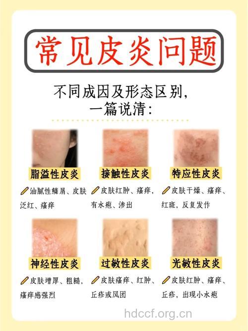 皮炎的症状有哪些呢