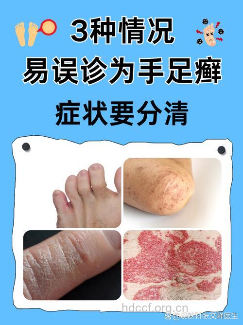 手足癣的发病原因 你真的了解吗