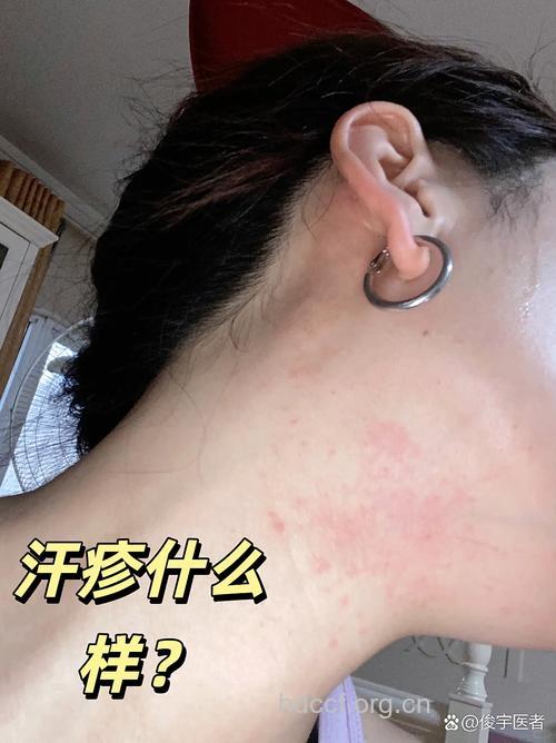 女性皮炎高发原是给汗“添堵”