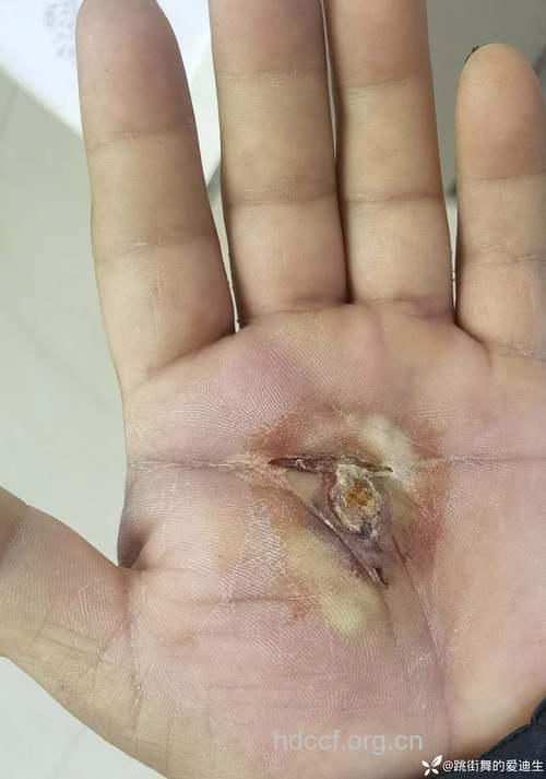 手掌深部间隙感染应该如何治疗