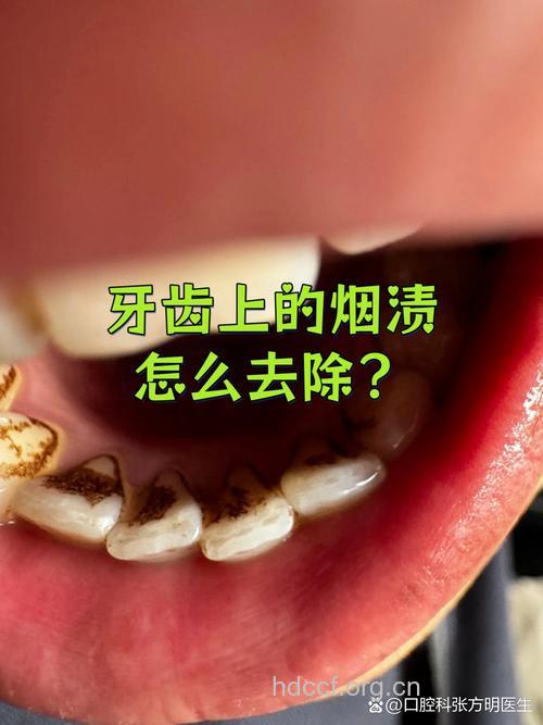 你知道吗?吸二手烟容易导致蛀牙