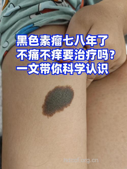 芝麻素能抑制皮肤癌