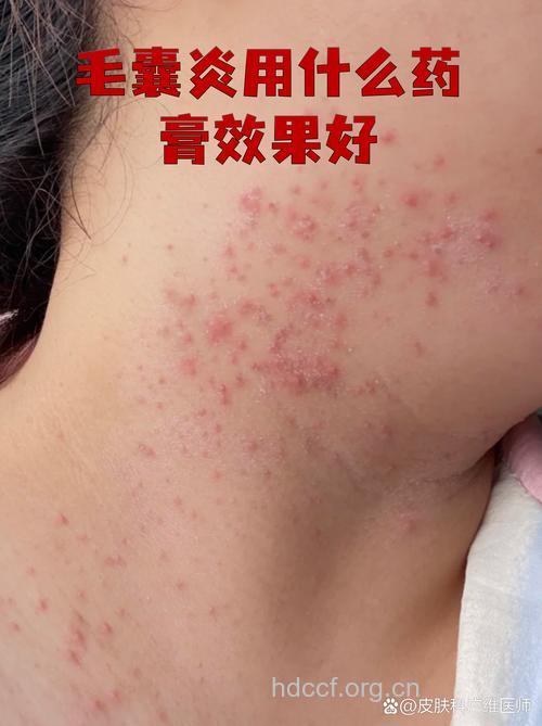 外用激素不当可致毛囊炎