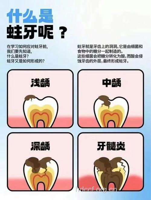 蛀牙认识误区 虫牙不是虫子咬的