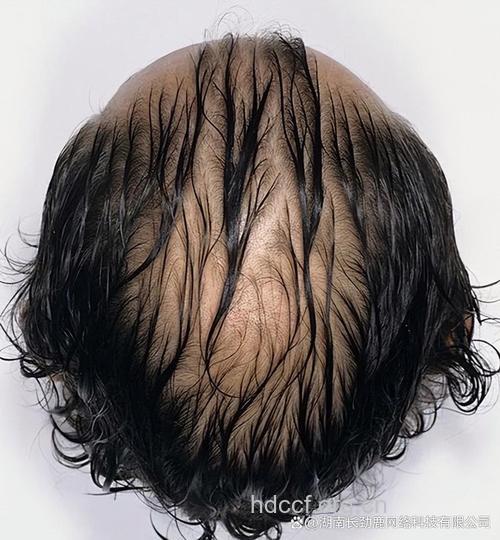 戴帽子“不对路”加重脱发